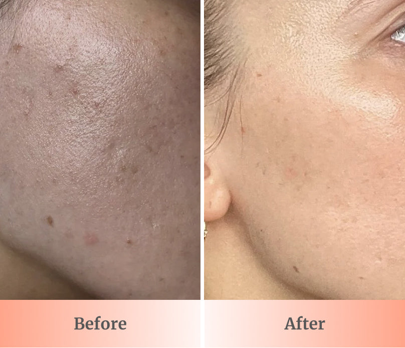 GlowUp™ LED Light Therapy Face Mask