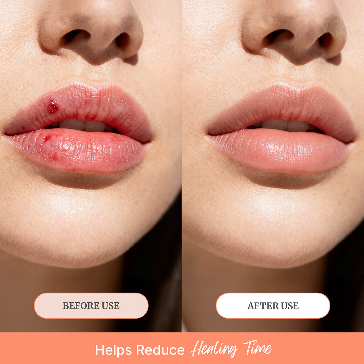 ClearLip™ Cold Sore Wand