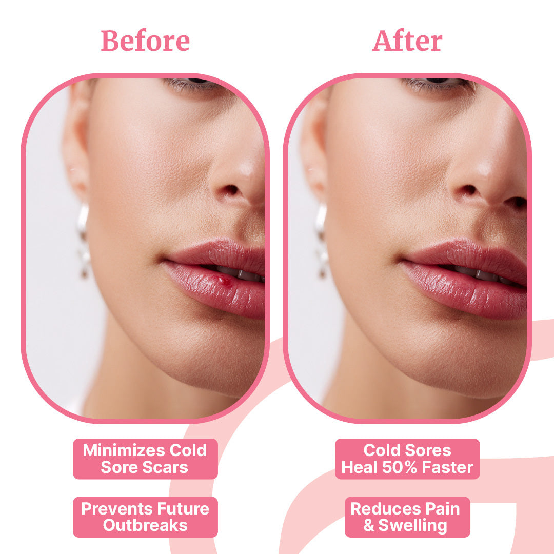 ClearLip™ Cold Sore Wand